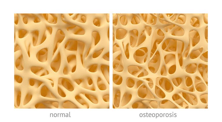 Images of normal bone density versus low bone density