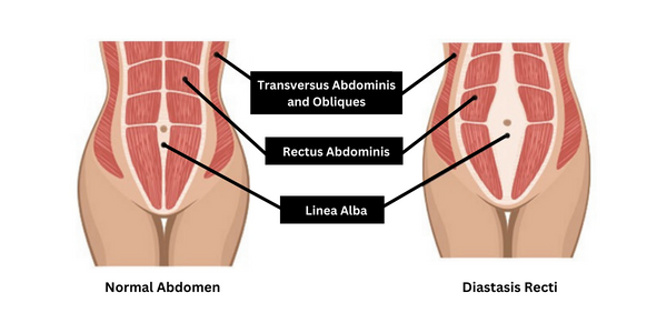 A diagram that compares the differences between normal abdomen muscles and abdomen muscles with diastasis recti